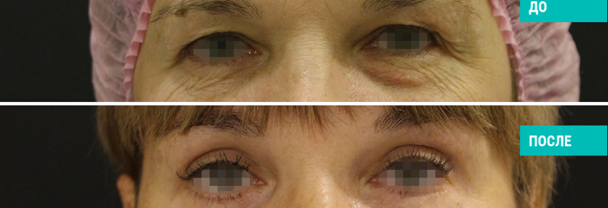 Блефаропластика