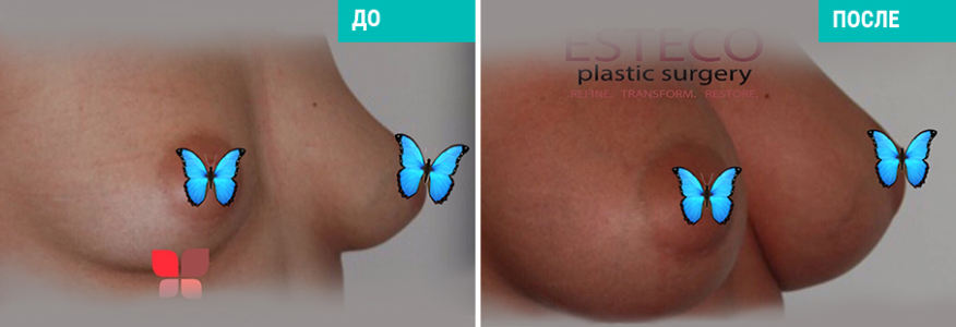 Маммопластика