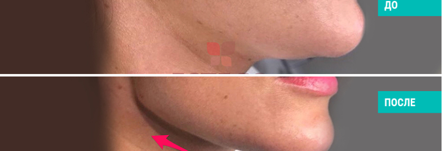 Моделировние лица гиалуроновой кислотой