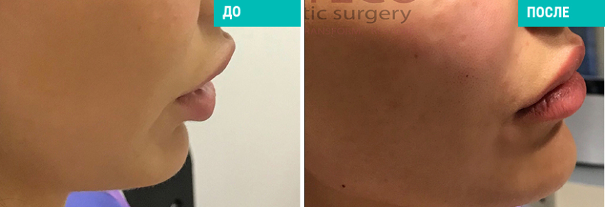 Моделировние лица гиалуроновой кислотой 