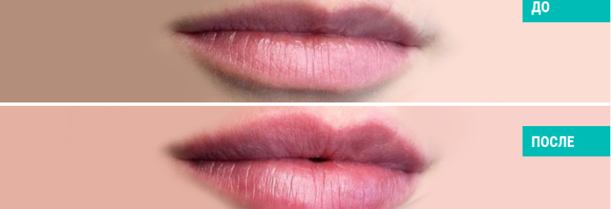 Увеличение губ