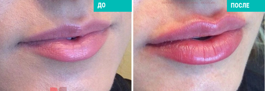 Увеличение губ