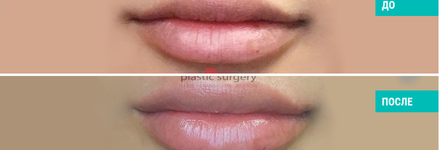 Увеличение губ