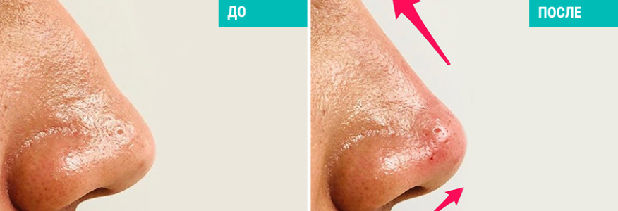 Безоперационная ринопластика