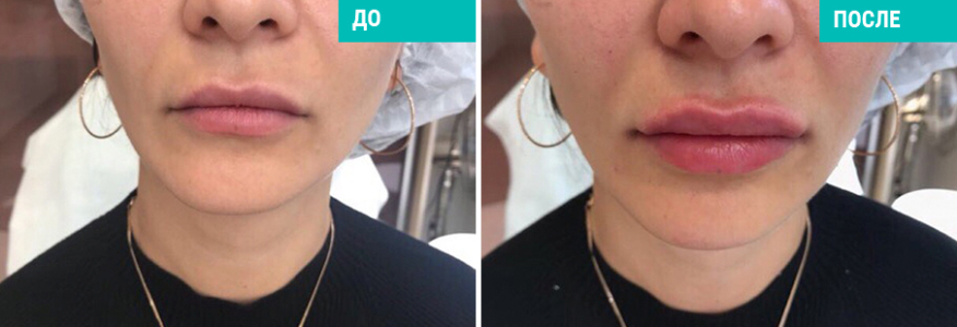 Коррекция подбородка