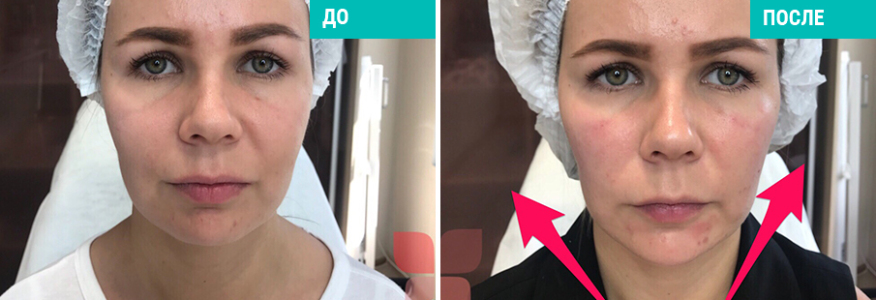 Ботулинотерапия+моделирование лица