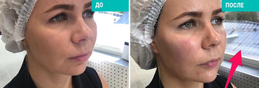 Ботулинотерапия+моделирование лица