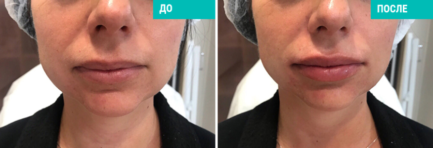 Ботулинотерапия+моделирование лица