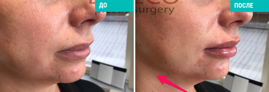 Ботулинотерапия+моделирование лица