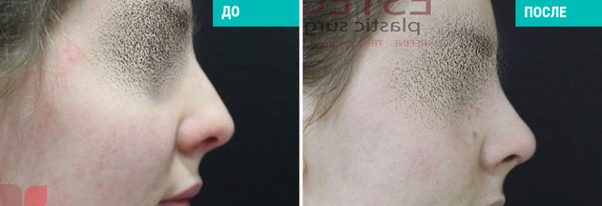 Ринопластика