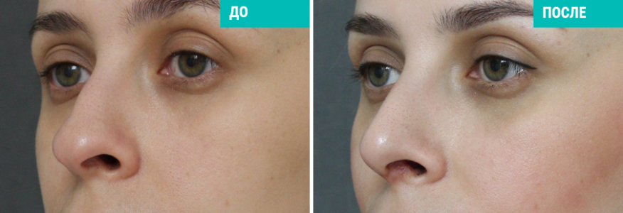 Ринопластика