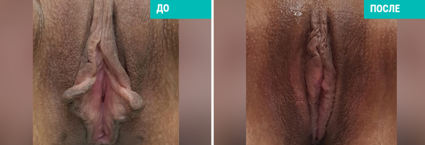 Интимная пластика