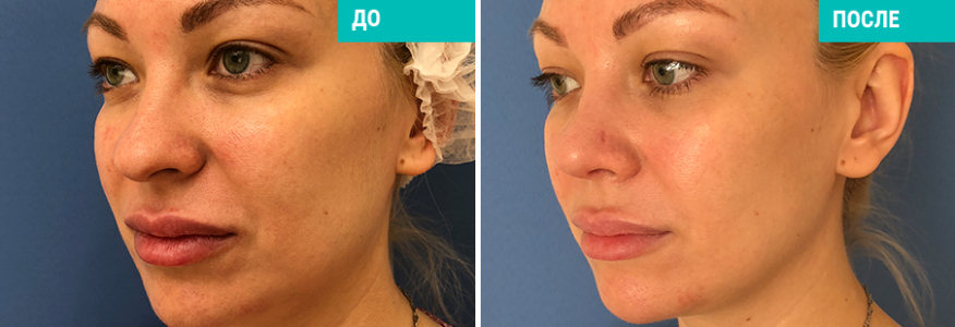 Ринопластика