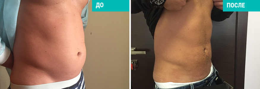 Липосакция 