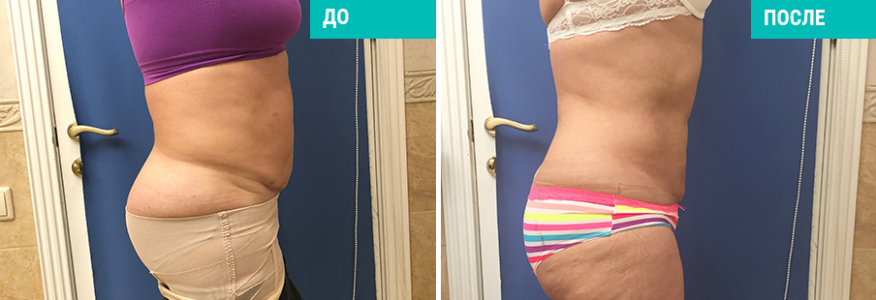 Липосакция 