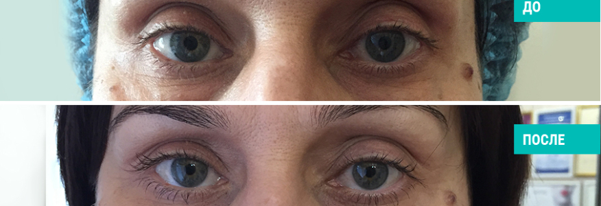 Блефаропластика