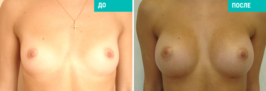 Увеличение груди