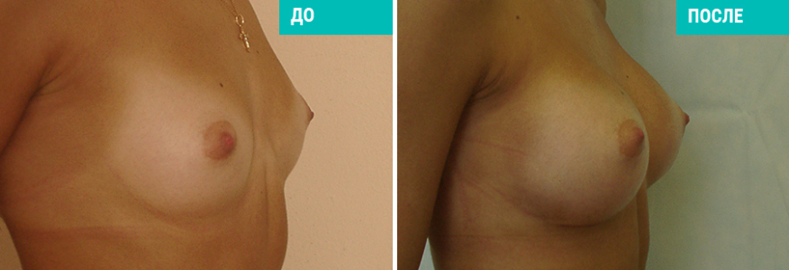 Увеличение груди
