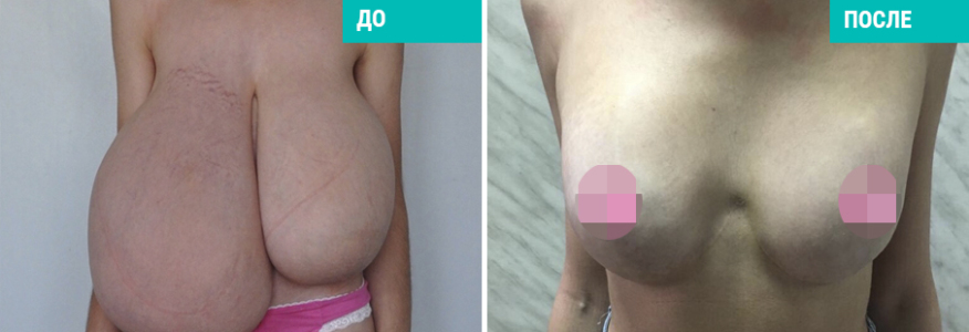 Уменьшение груди