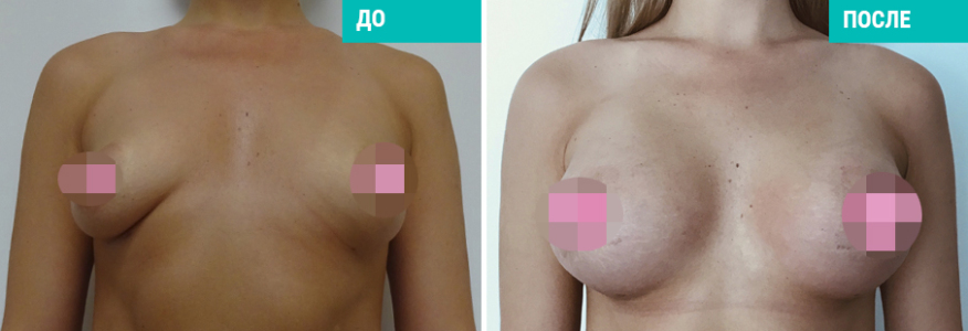 Увеличение и преареолярная подтяжка