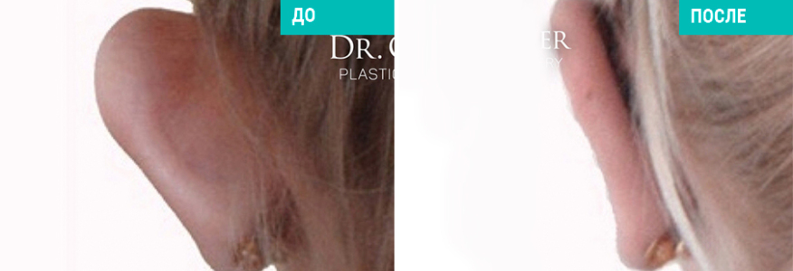 Отопластика