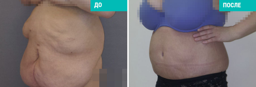 Абдоминопластика 