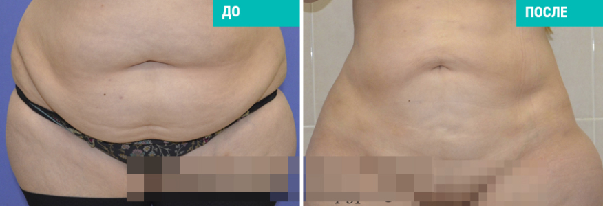 Липосакция