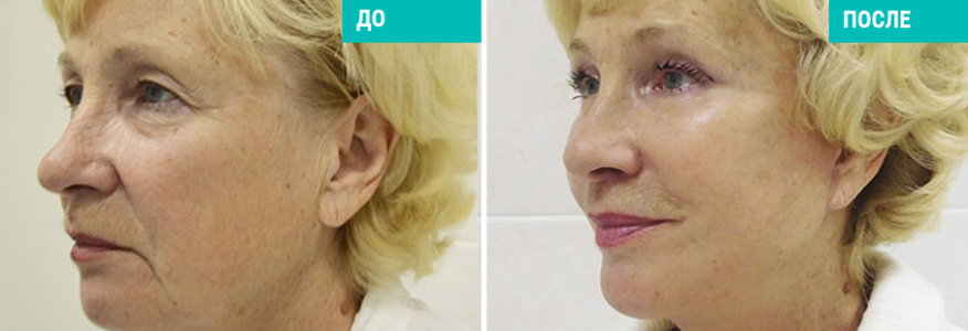 Подтяжка лица