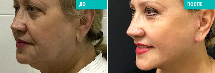 Подтяжка лица