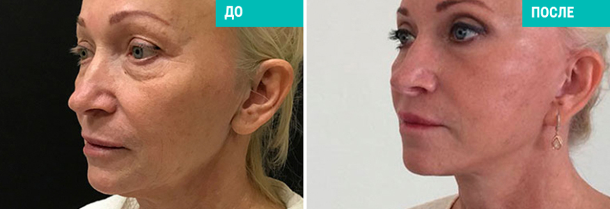 Подтяжка лица