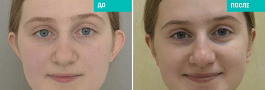 Отопластика