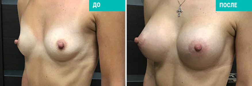 Увеличение груди