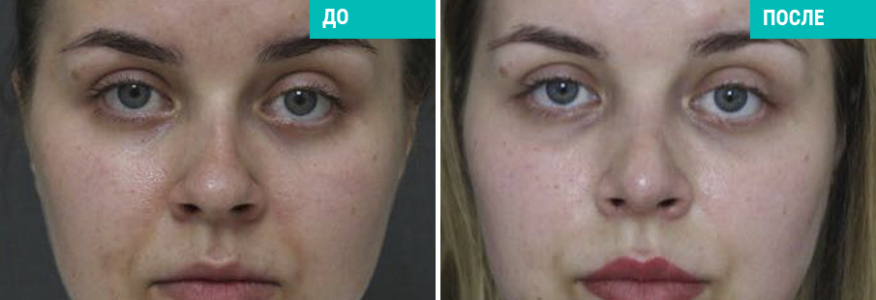 Ринопластика