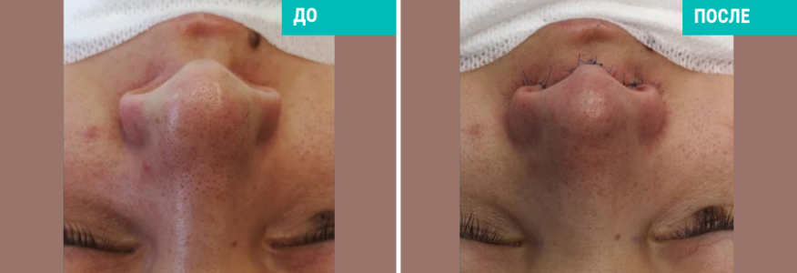 Ринопластика