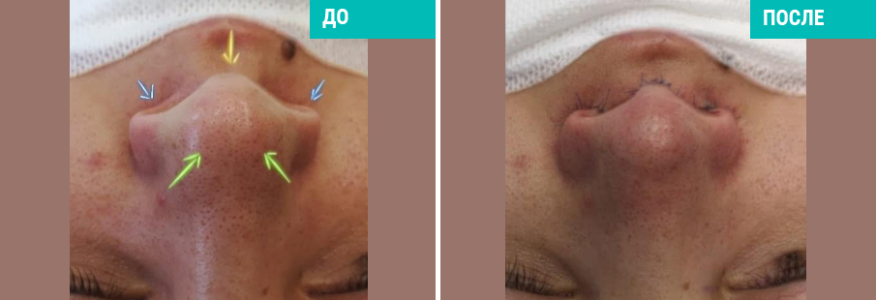 Ринопластика