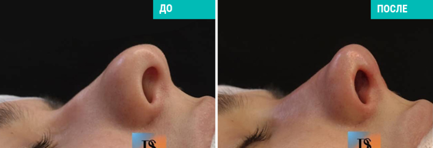 Ринопластика