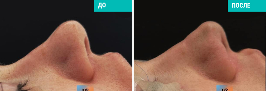 Ринопластика