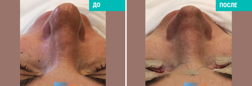 Ринопластика