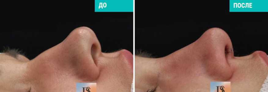 Ринопластика