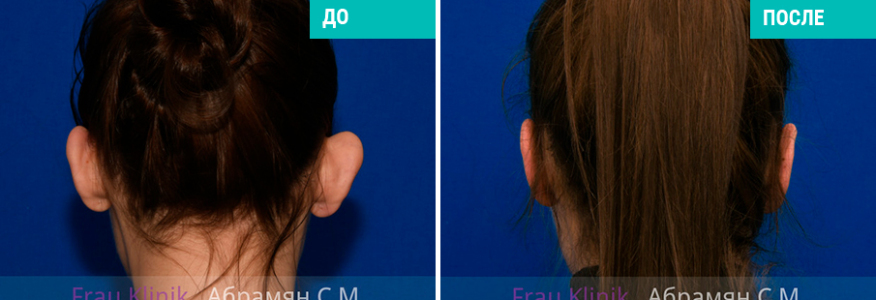 Отопластика