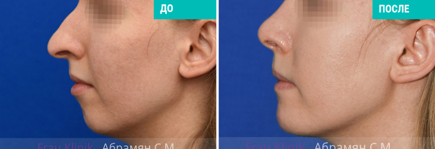 Пластика носа