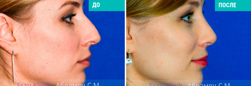 Пластика носа