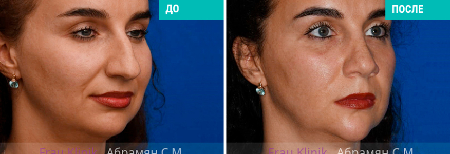 Пластика носа