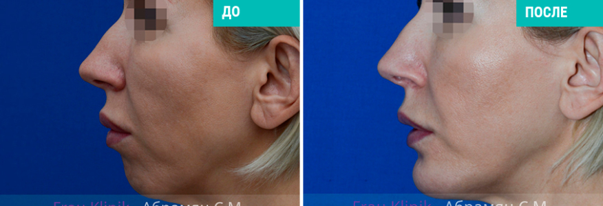 Пластика подбородка