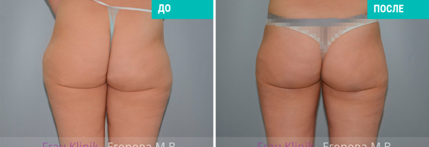 Липосакция