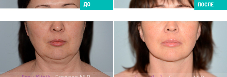 Пластика лица