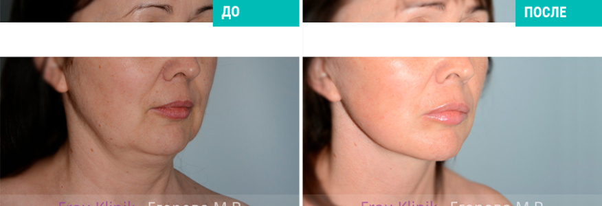 Пластика лица