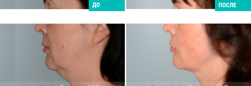 Пластика лица