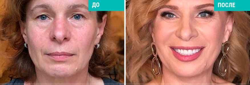 Пластика лица