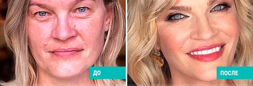 Пластика лица